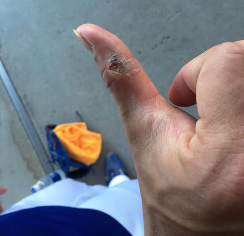沖縄秋季キャンプで又吉が作った指のタコ（2018年11月8日撮影）