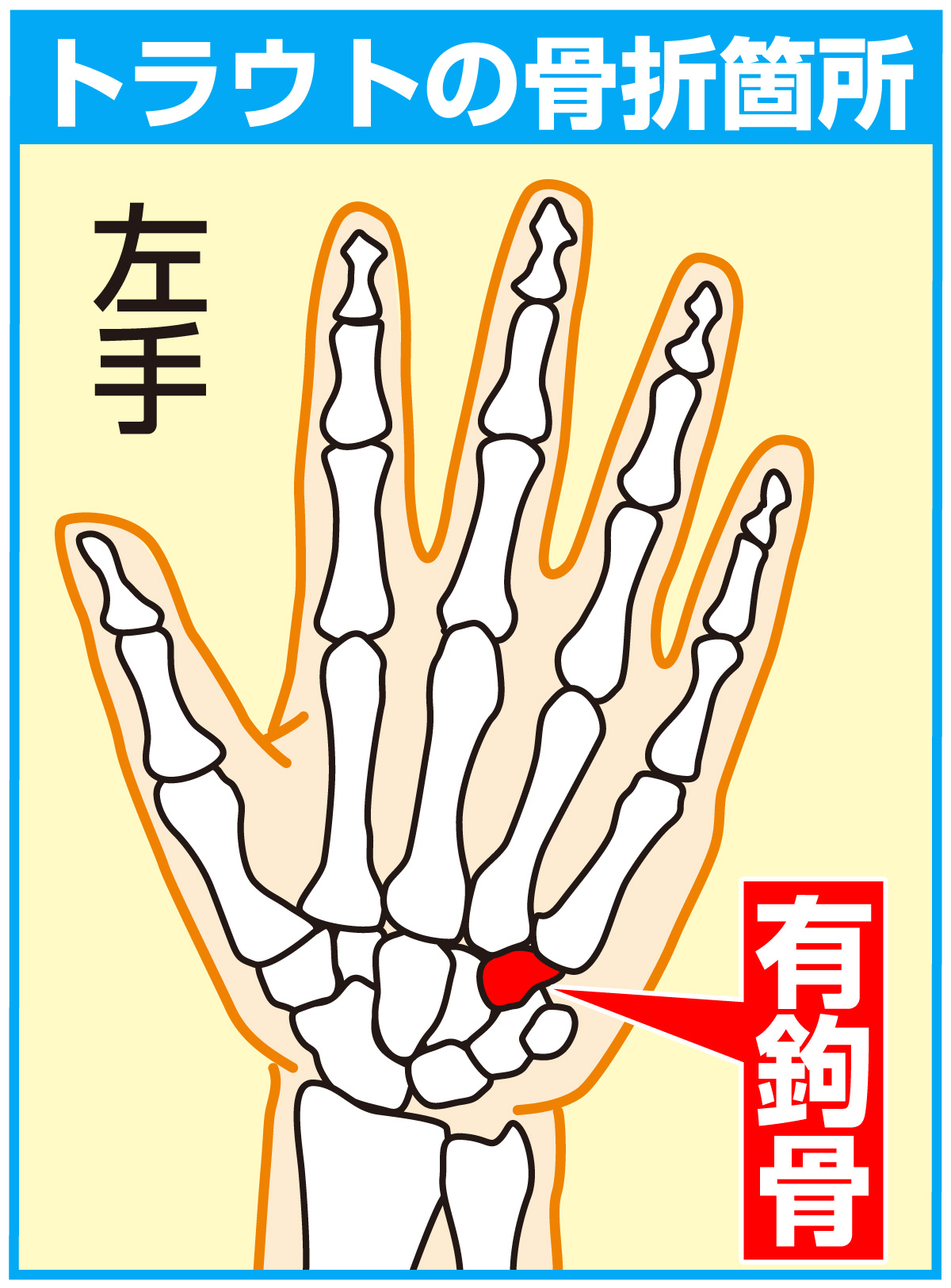 【イラスト】エンゼルス・トラウトの骨折個所
