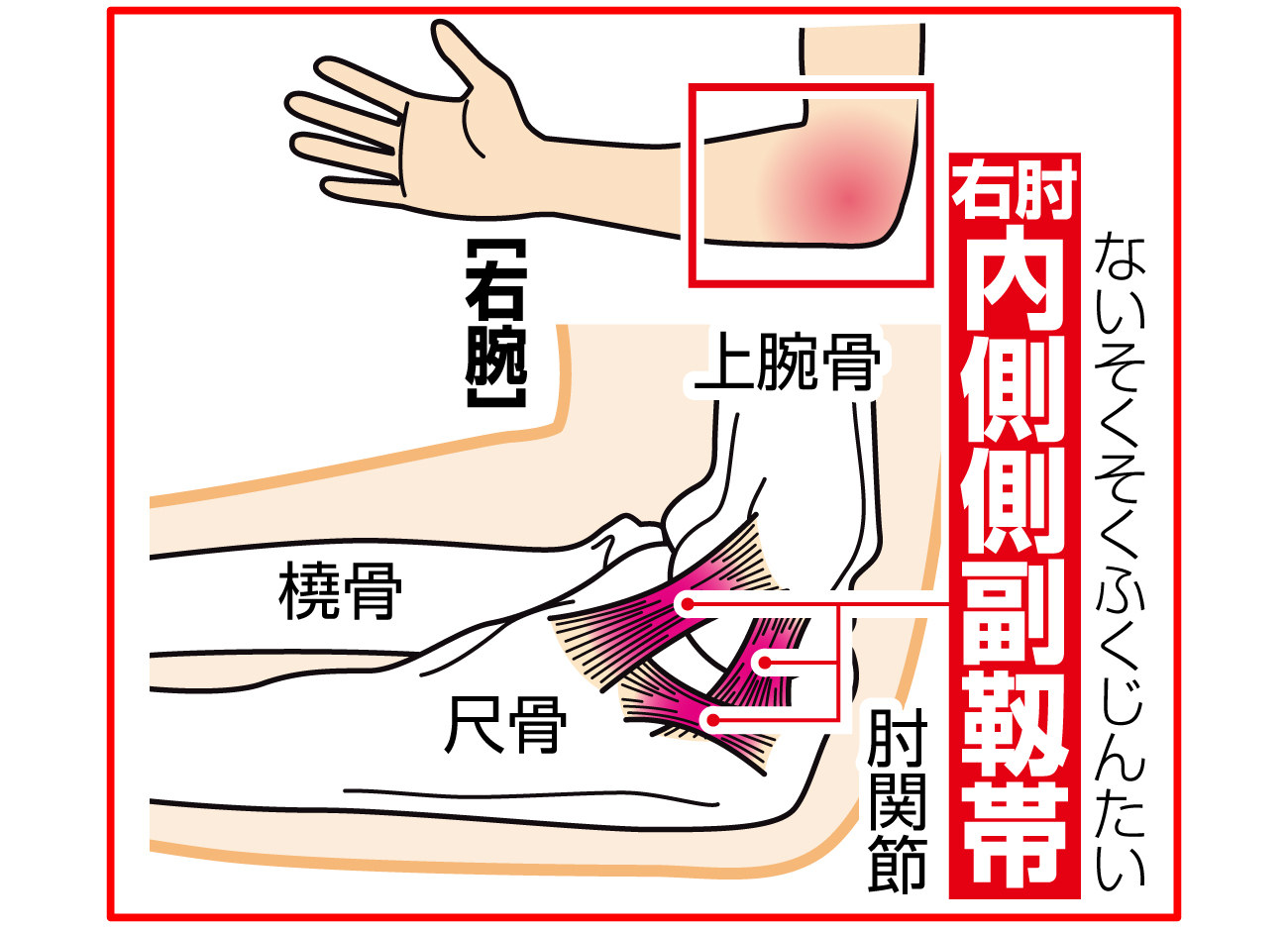 【イラスト】大谷の損傷した右肘内側側副靭帯