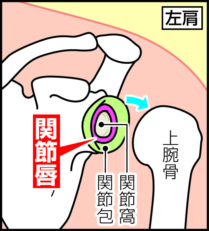 【イラスト】左肩関節唇の位置