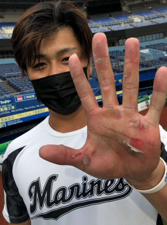 打ち込みでめくれたロッテ山口の手のひら（球団提供）