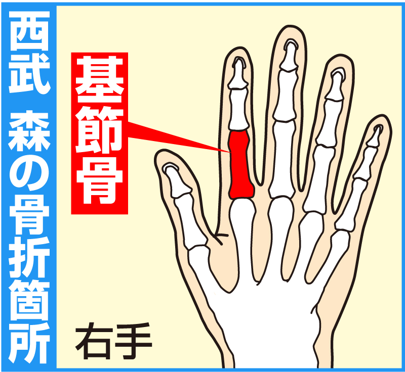 西武森の骨折箇所