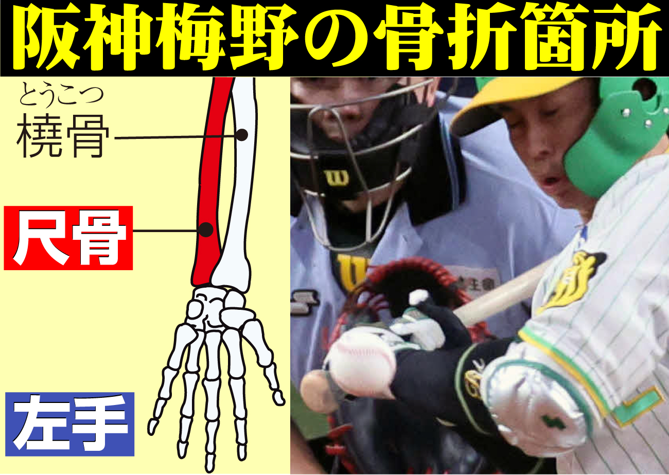 【イラスト】阪神梅野の骨折個所
