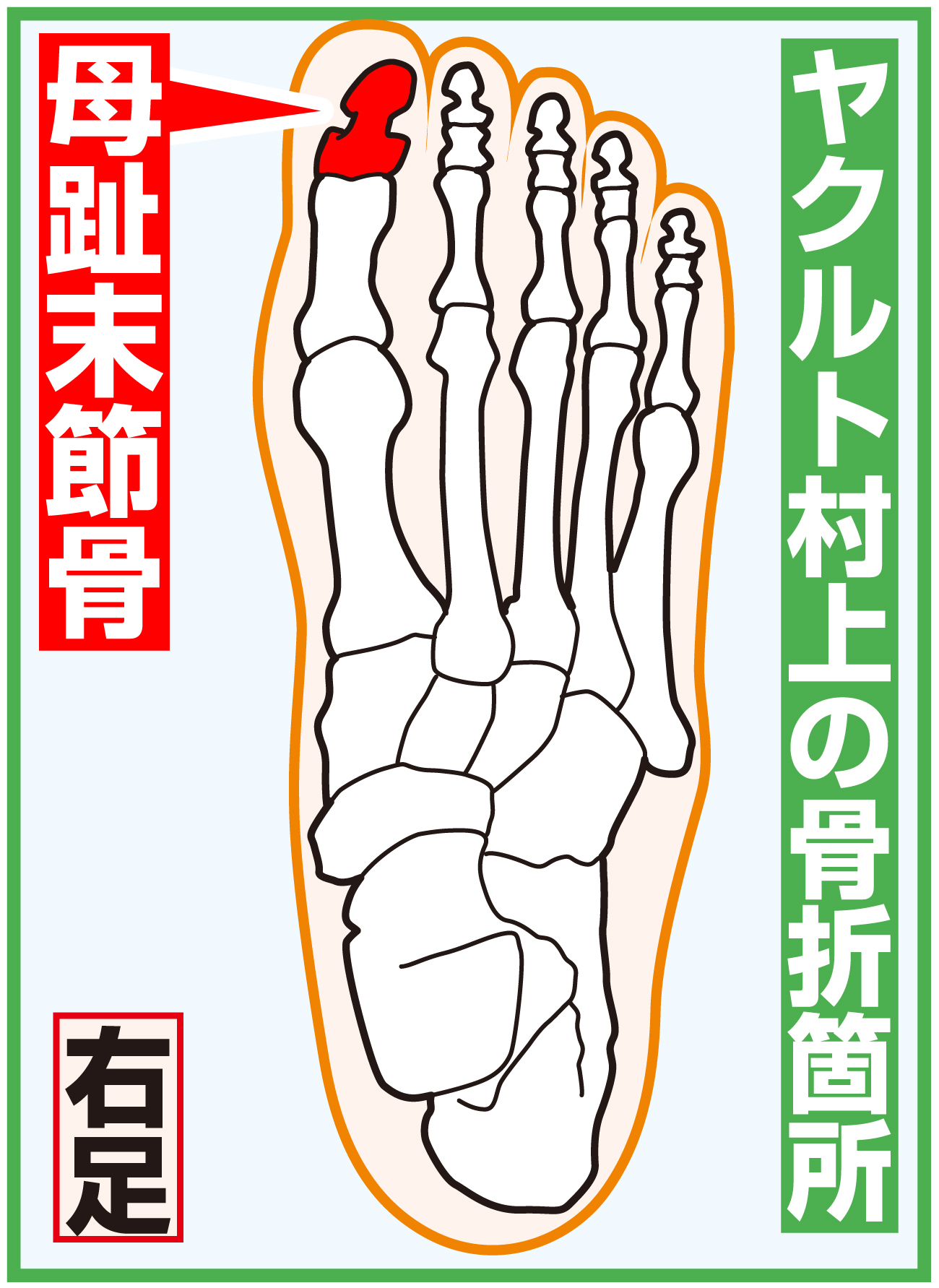 【イラスト】ヤクルト村上の骨折箇所