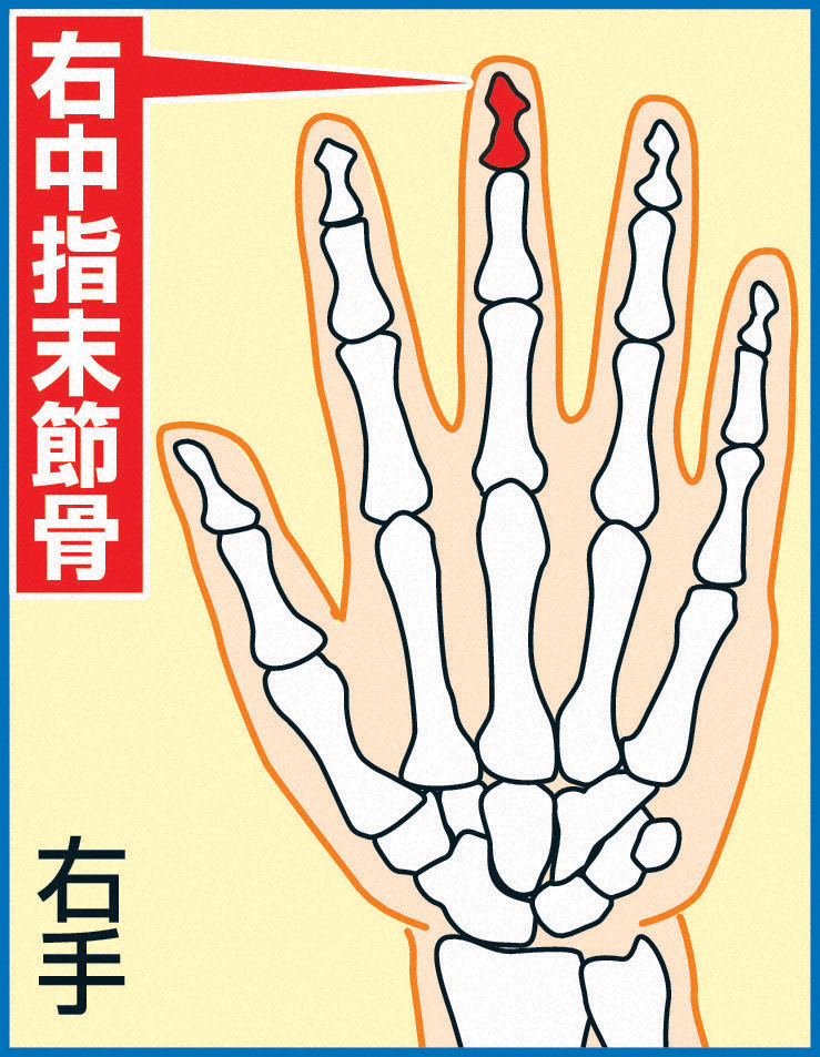 右中指末節骨