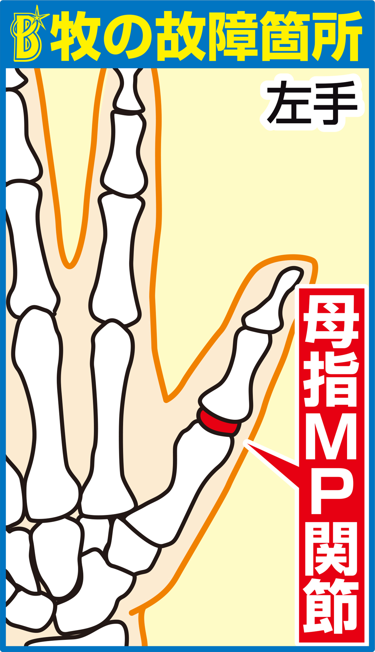 DeNA牧の手術箇所