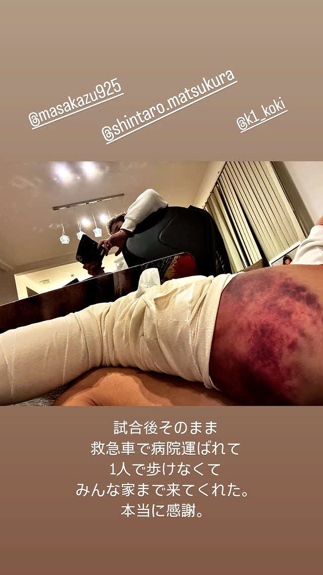 武尊のインスタグラムのストーリーにアップされた左太もも裏の写真。スーパーレックのキックで紫色に腫れ上がっている