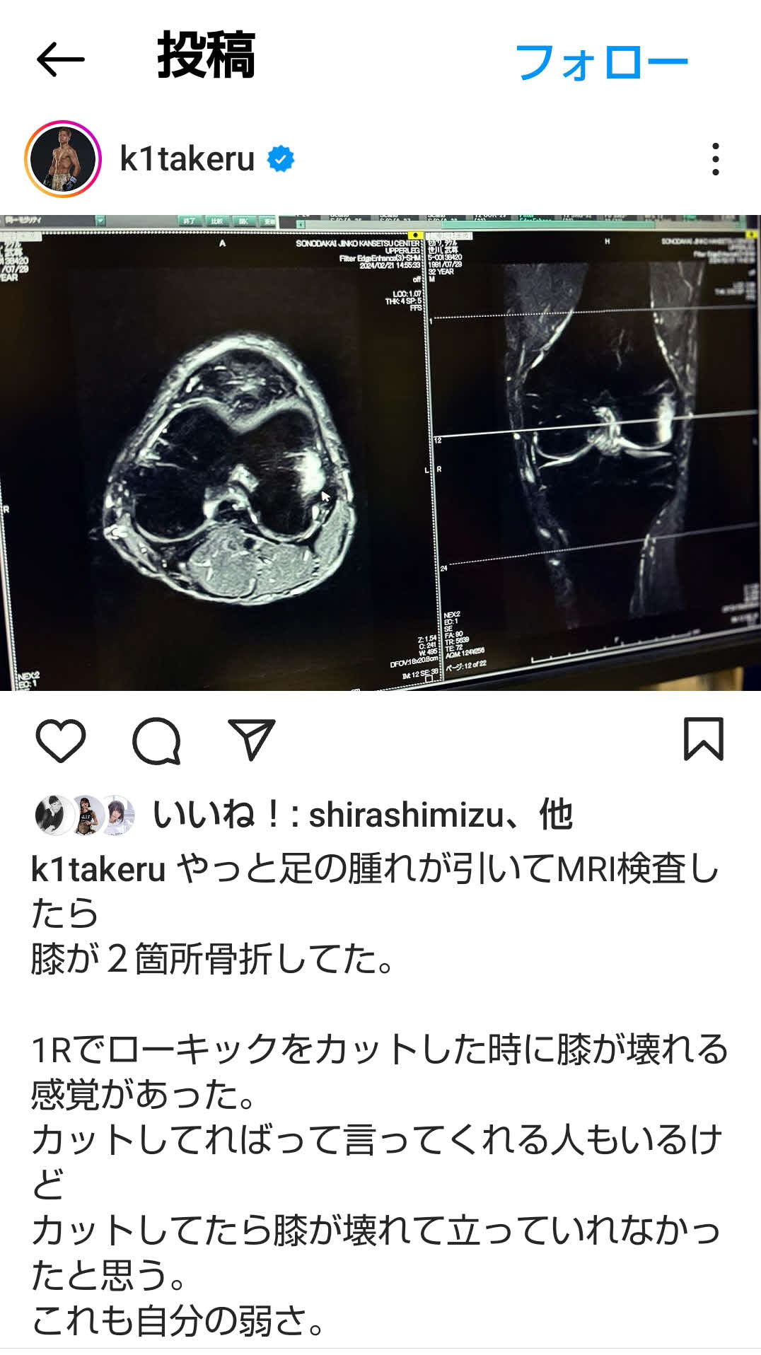 MRI検査で武尊の膝が2カ所骨折していることが発覚した（武尊のインスタグラムから）