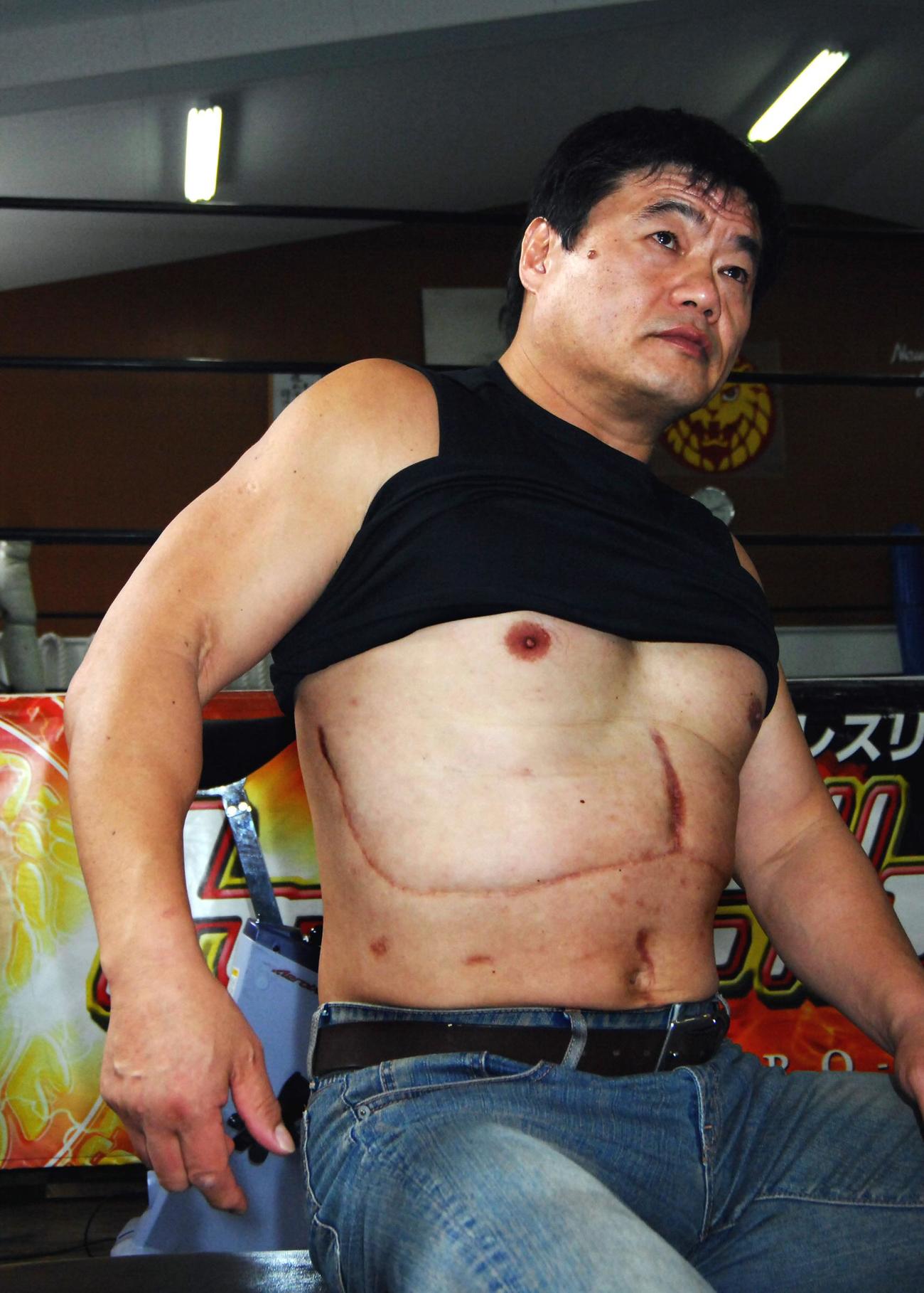 07年9月、腹部には肝臓ガンの手術あとが痛々しく残っていた