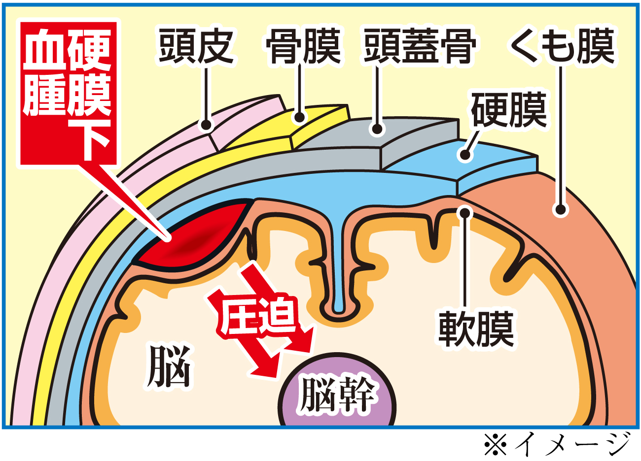 【イラスト】硬膜下血腫のイメージ図