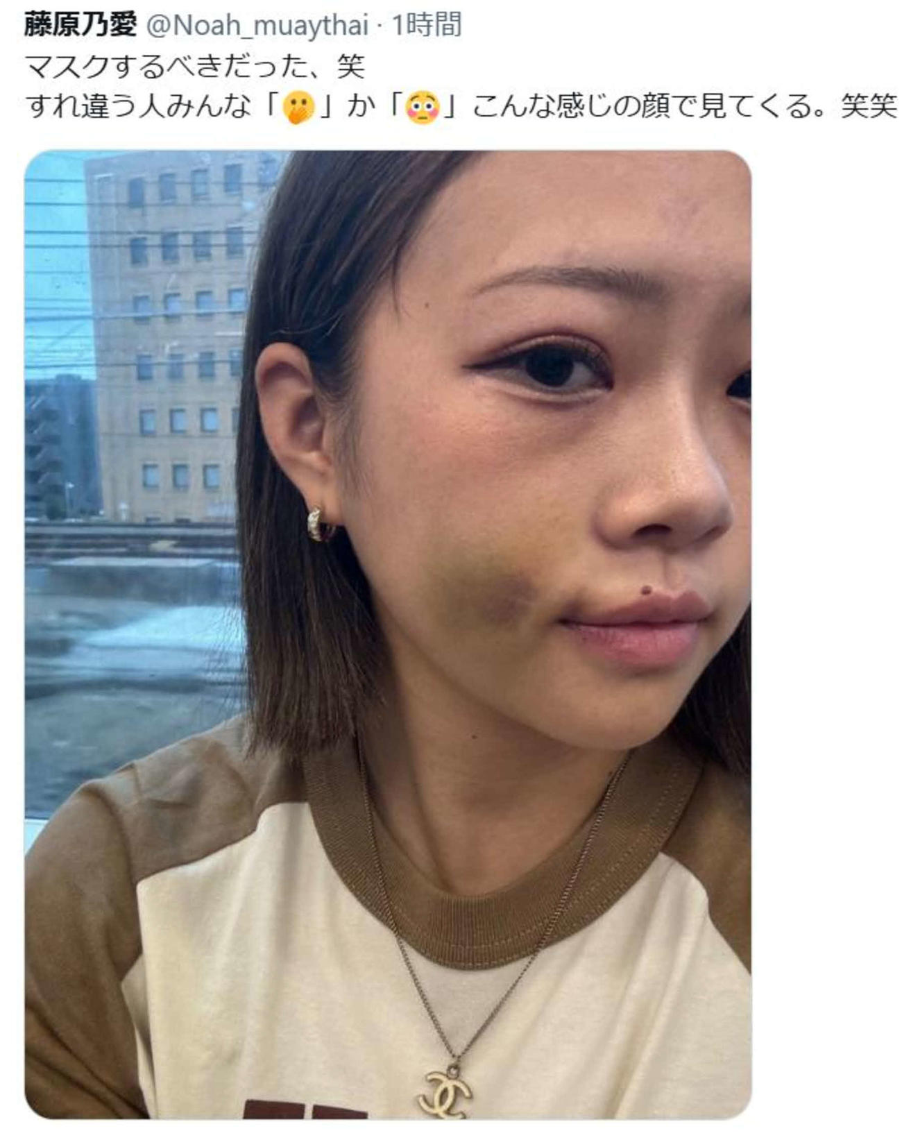 顔にアザができた写真をXにアップした藤原乃愛