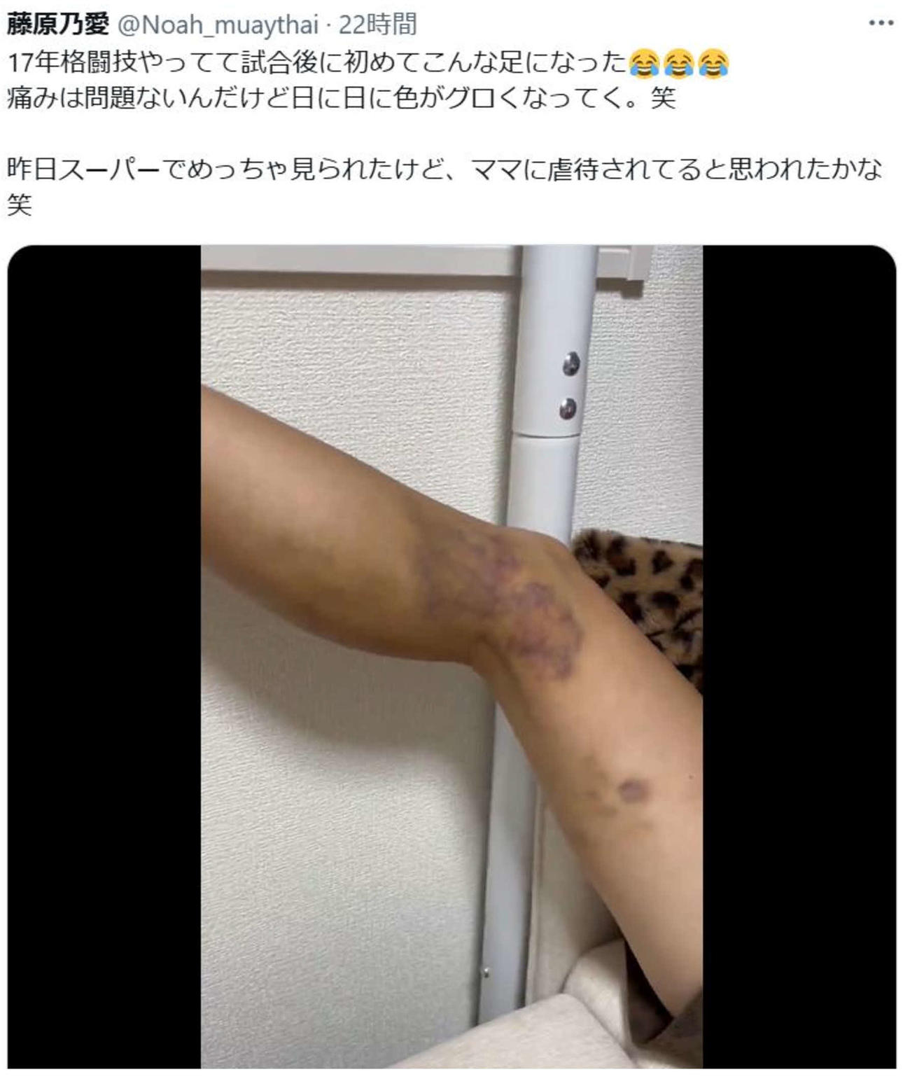 藤原乃愛は赤黒く腫れた足の動画をXにアップした