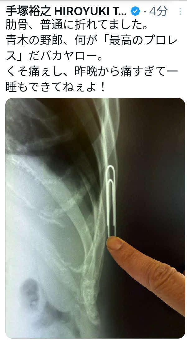 手塚裕之はXで肋骨を骨折していたことを明らかにした