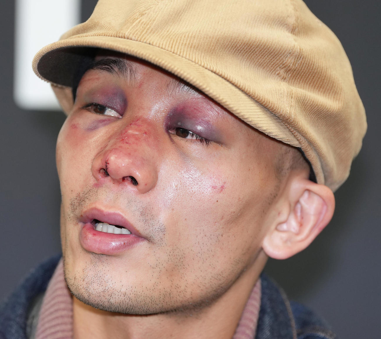一夜明け、痛々しい顔で試合を振り返る堤（撮影・足立雅史）