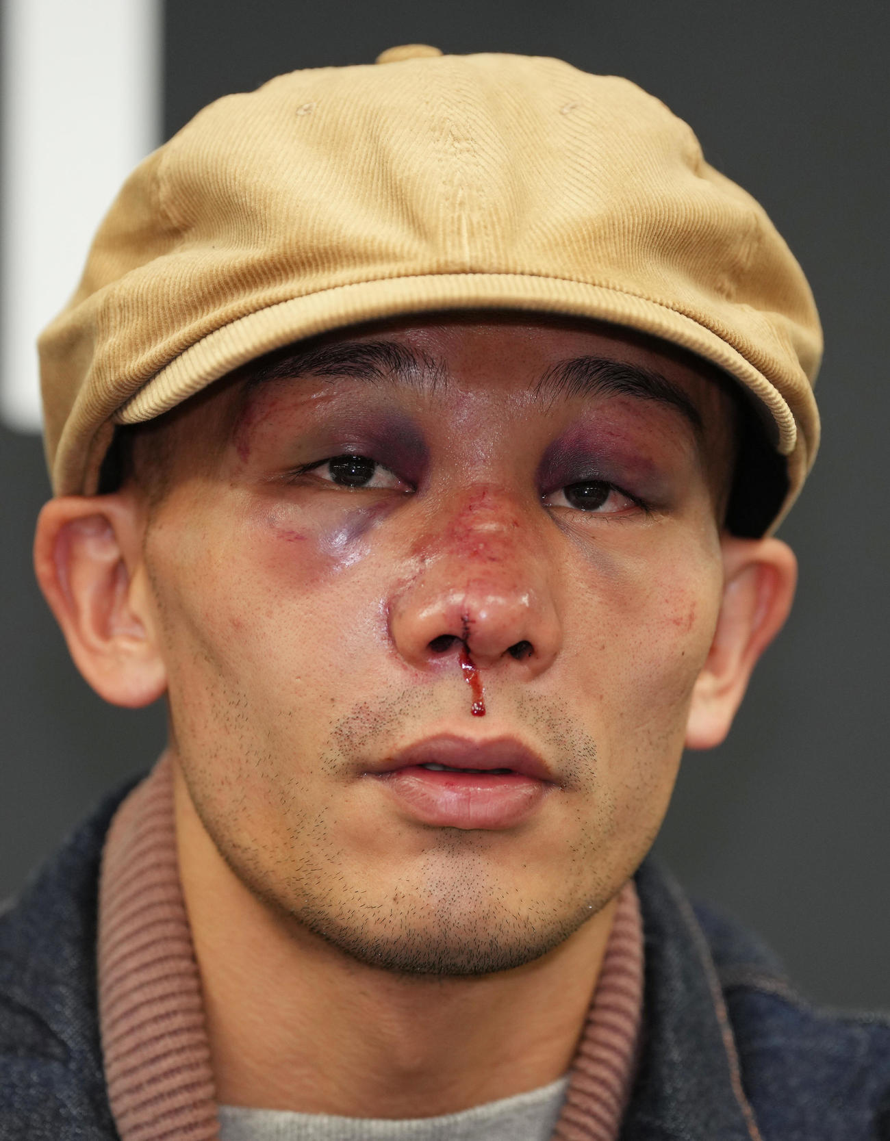 一夜明け、会見に臨んだ堤聖也は負傷した鼻から血が垂れる（撮影・足立雅史）