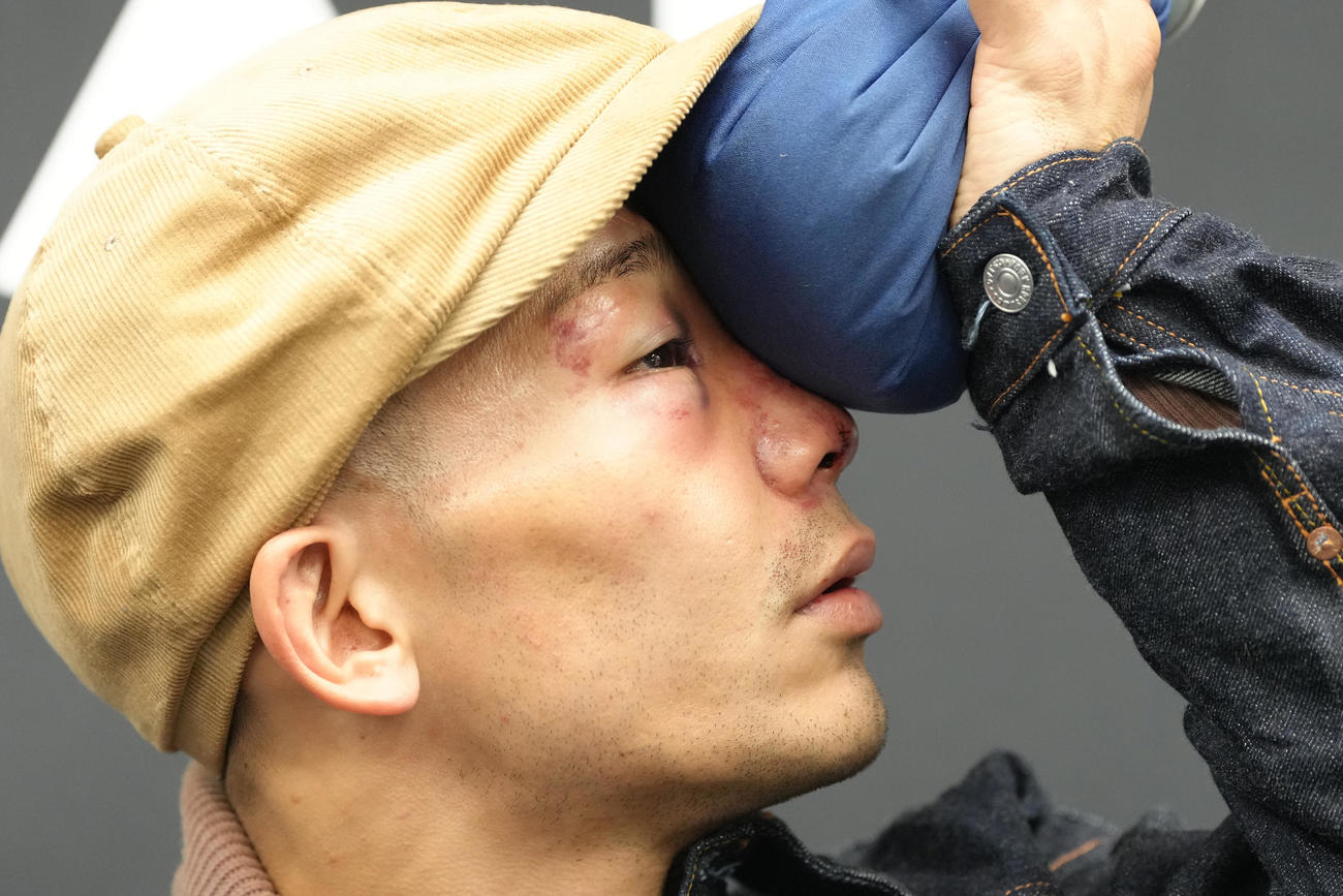 一夜明け、氷のうで顔を冷やしながら会見に臨む堤（撮影・足立雅史）