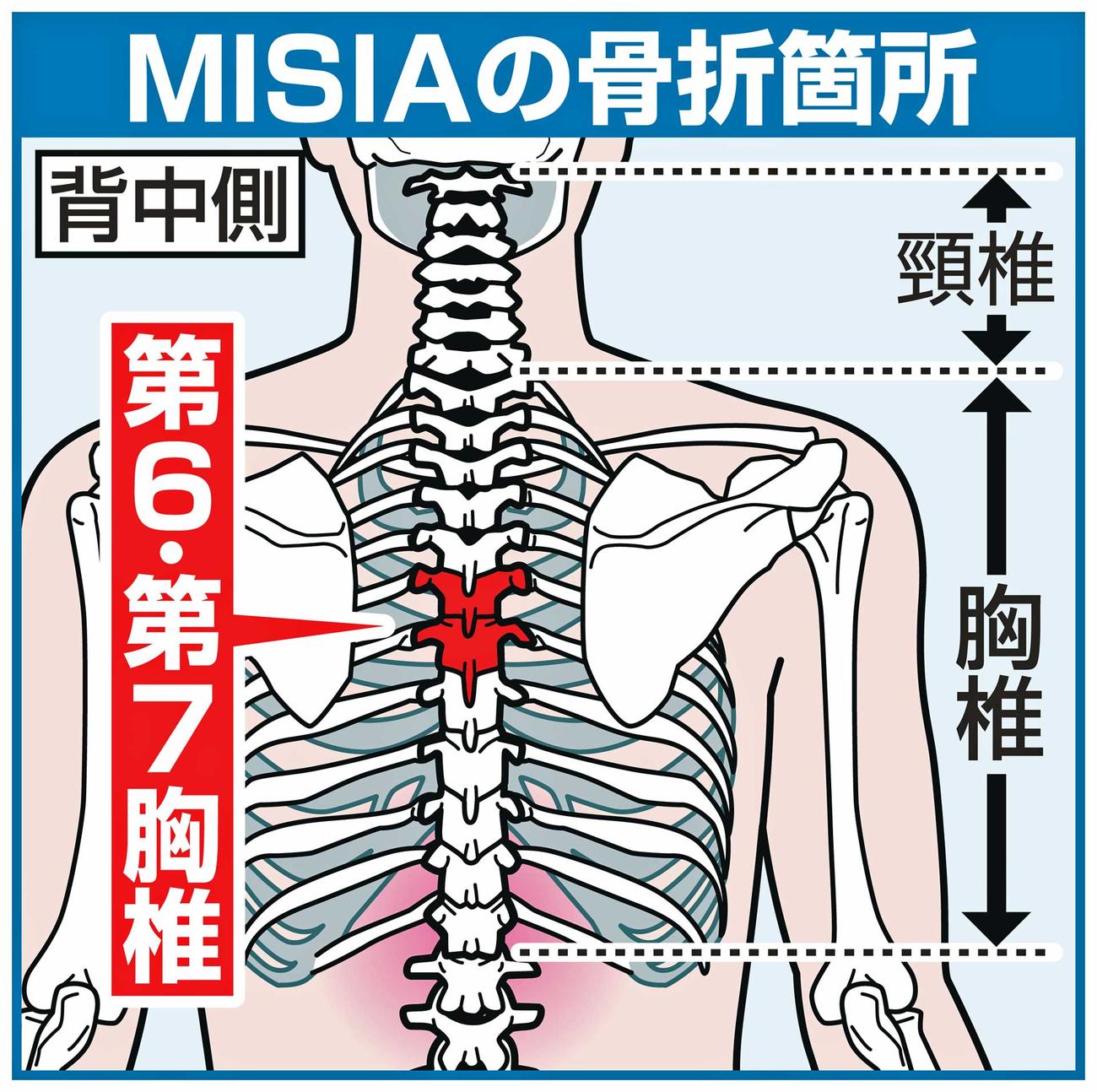 MISIAの骨折箇所