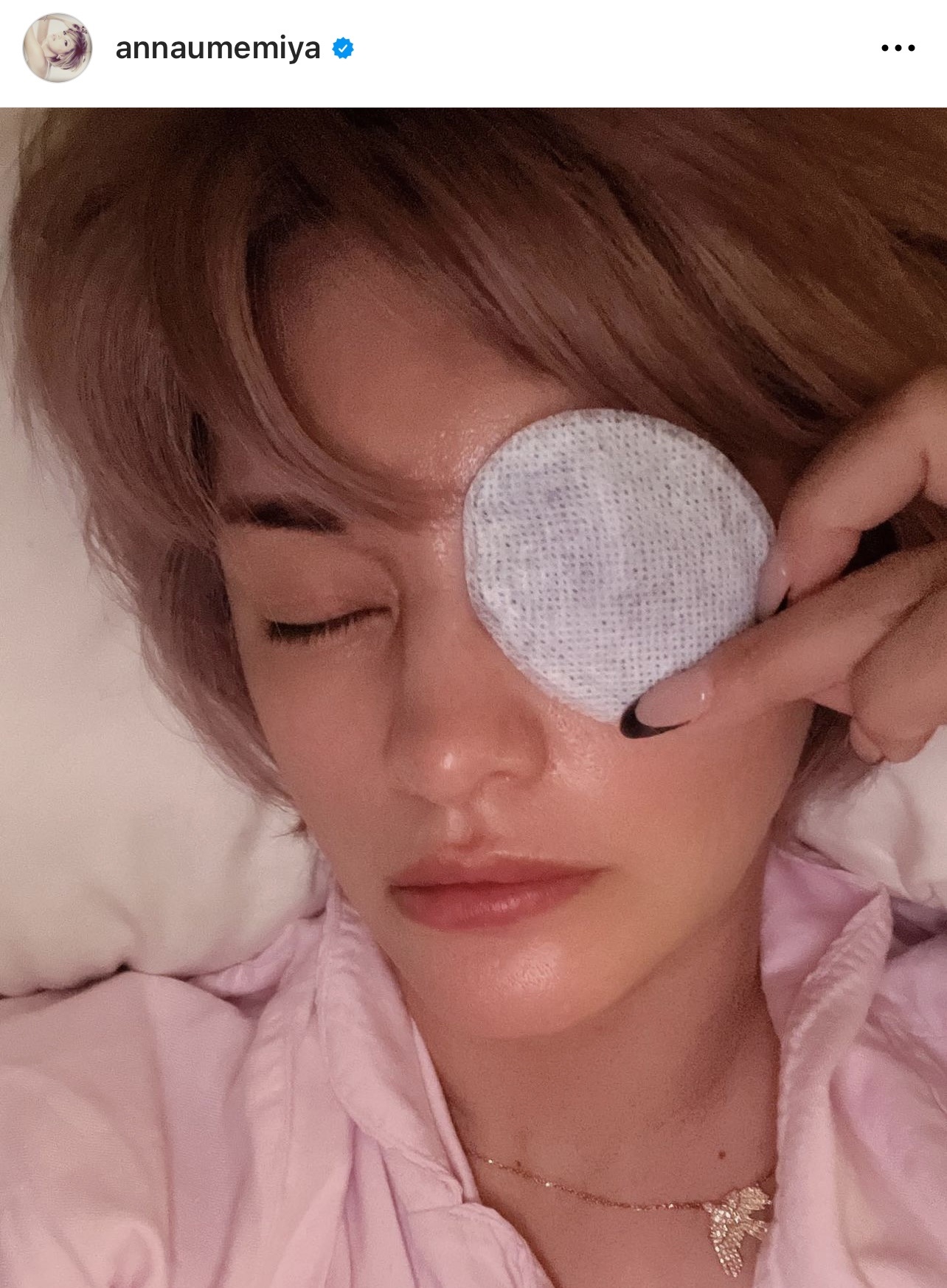 左眼に眼帯を貼った写真をアップした梅宮アンナ（梅宮アンナのインスタグラムから）
