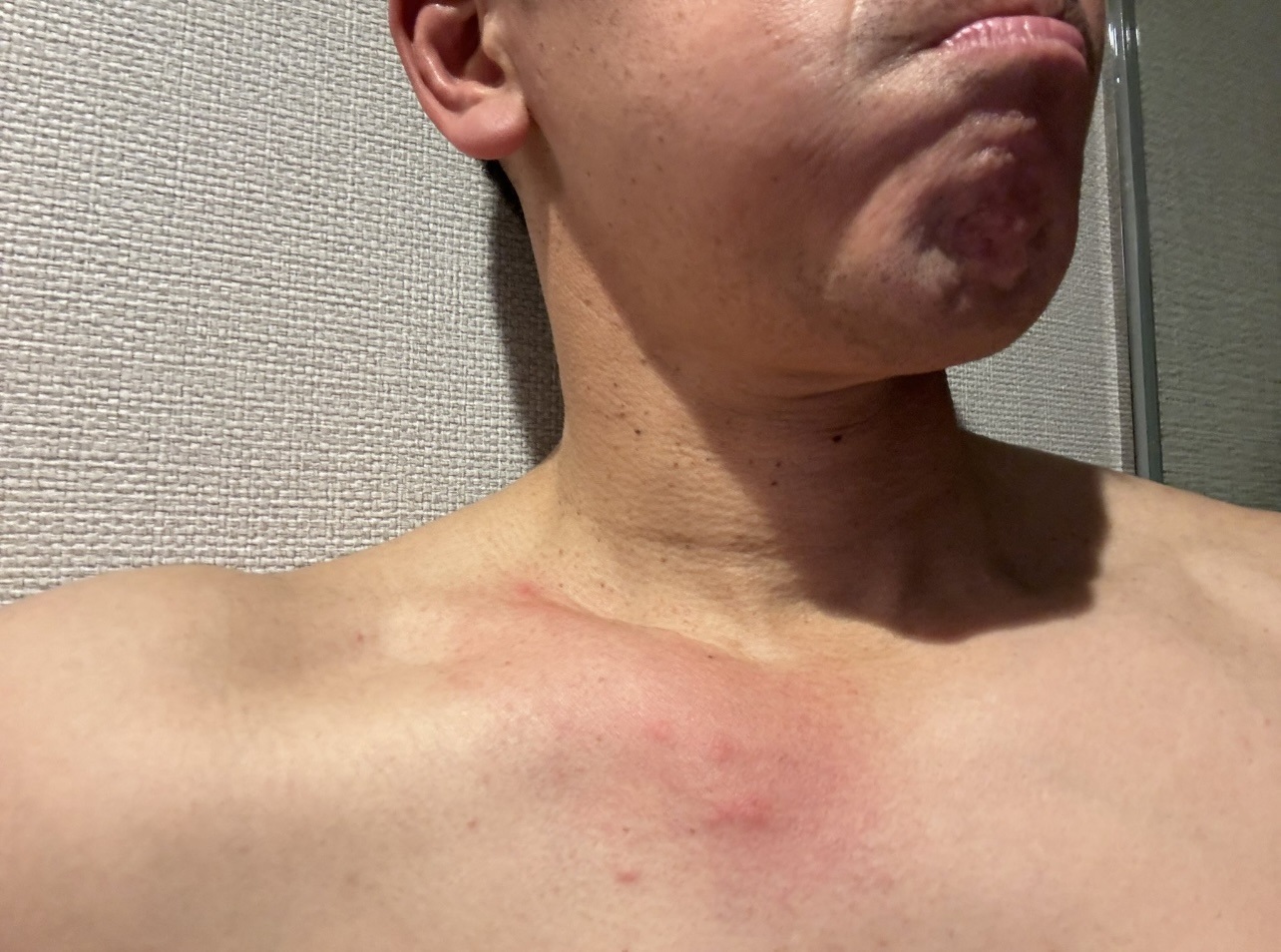 鎖骨あたりが赤く腫れ、斑点ができているかのような写真（武井壮のX（旧Twitter）から）