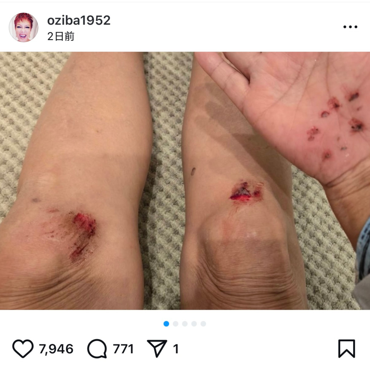 池畑慎之介の小学生みたいな怪我の様子（インスタグラムから）
