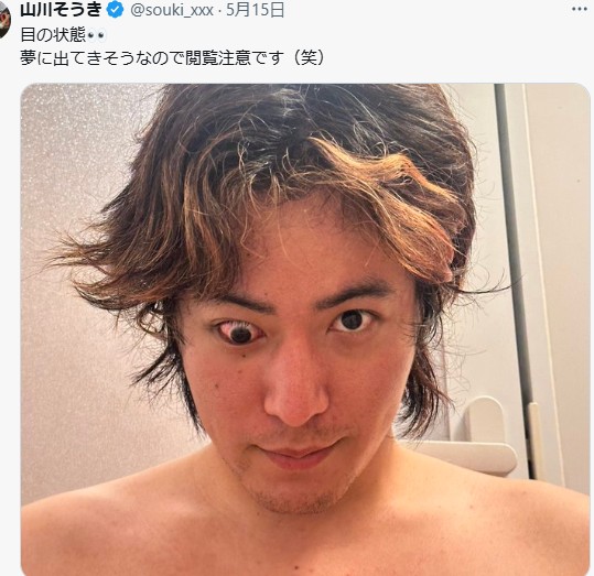 ５月15日に「夢に出てきそうなので閲覧注意」と記した上で目の現状についての写真を投稿した山川そうき（山川そうきのXから）