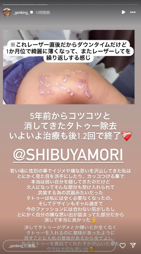 GENKING．が除去手術中のタトゥー（インスタグラムから）