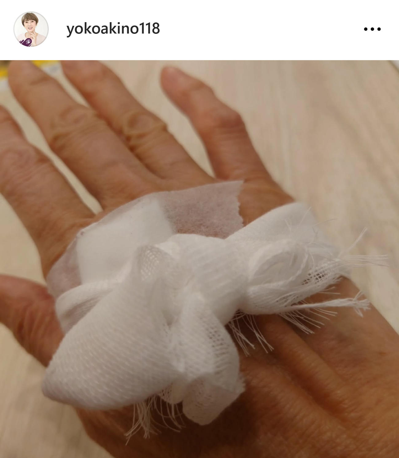 包帯が巻かれた痛々しい手の甲（秋野暢子のインスタグラムから）
