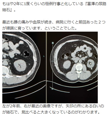 サンド富澤の尿路結石（ブログから）