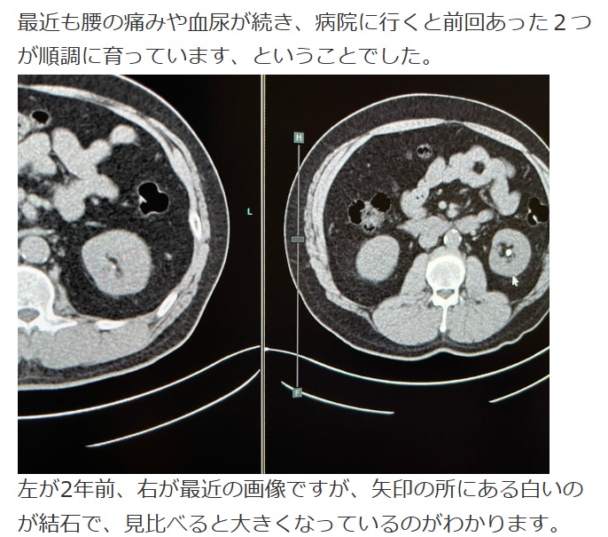 富澤たけしがブログに投稿した尿路結石の画像