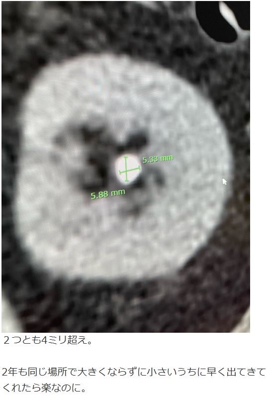 富澤たけしがブログに投稿した尿路結石の画像