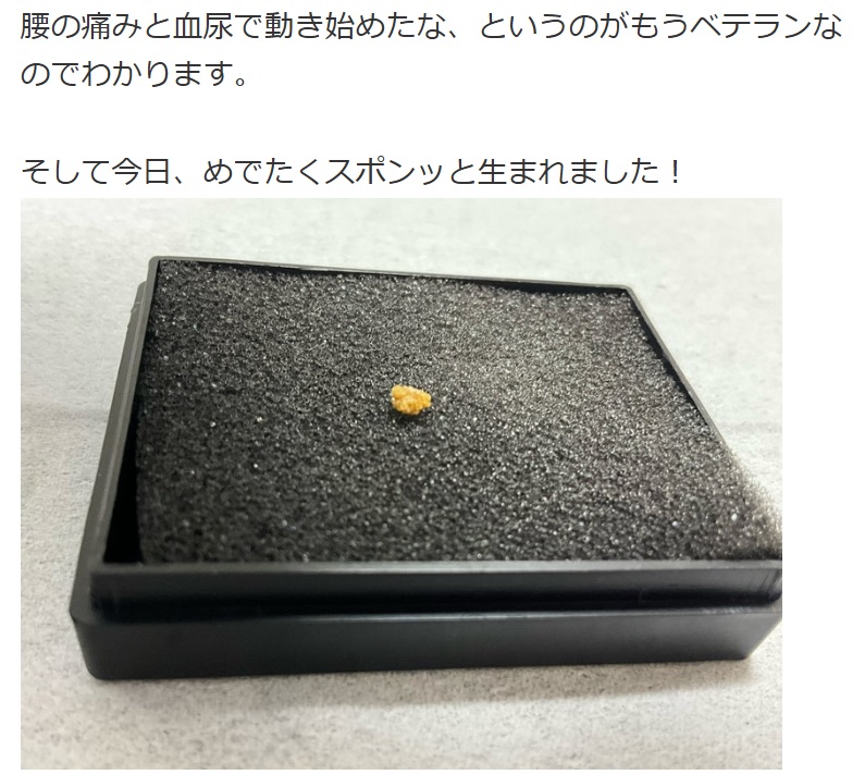 富澤たけしがブログに投稿した、体外に排出された尿路結石
