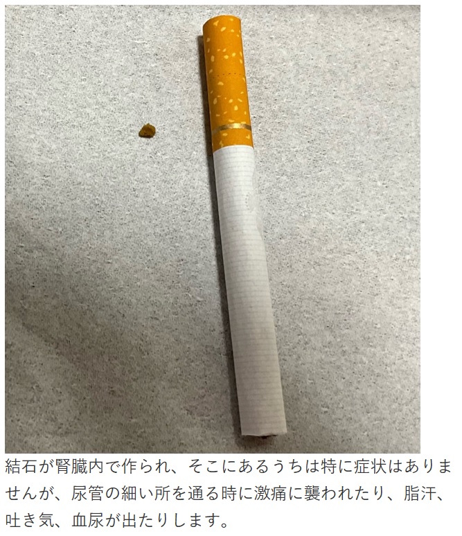 富澤たけしがブログに投稿した、体外に排出された尿路結石