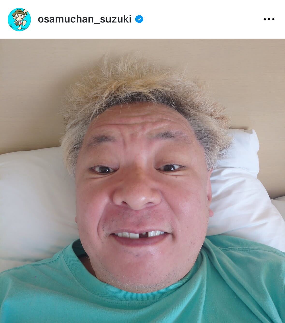 前歯が1本抜けた姿（鈴木おさむ氏のインスタグラムから）
