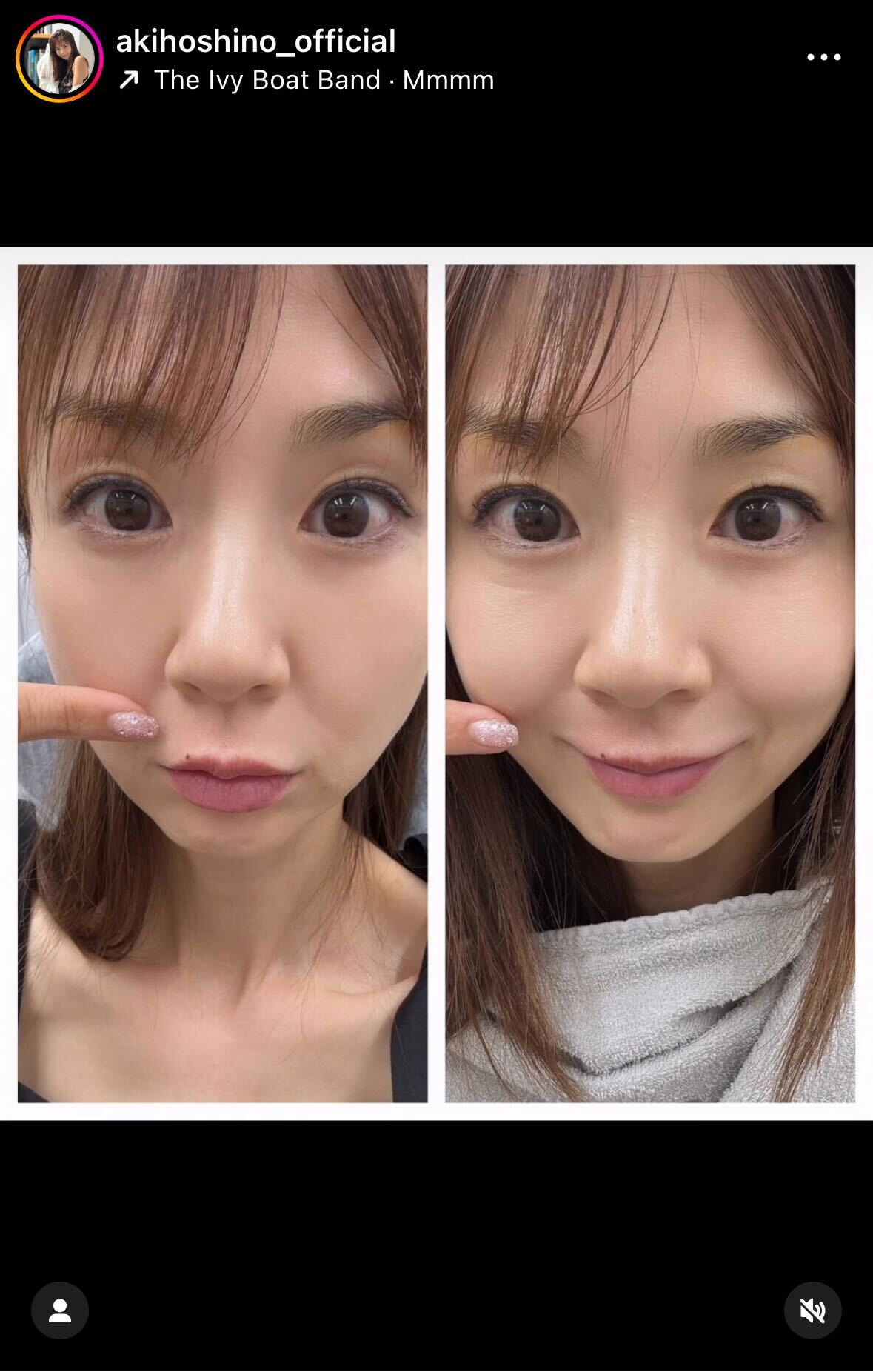 人中短縮レーザーbefore、after（ほしのあきのインスタグラムから）