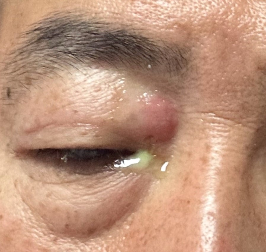 右の鼻の根元に水泡ができ、おできのようになって開かなくなった笠井信輔の右目