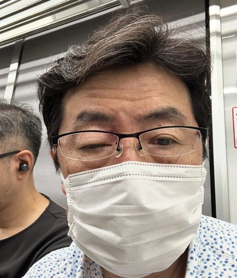 右目が腫れ上がり、まぶたが下がって開かなくなっても仕事を続けていた笠井信輔