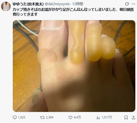 登録者160万人超のYouTuber 衝撃やけど写真 「カップ焼きそばのお湯が