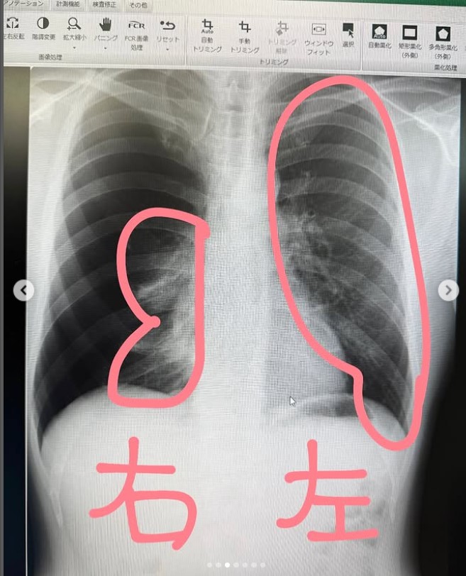 肺のエックス写真を公開したStaxx T（Staxx Tのインスタグラムから）