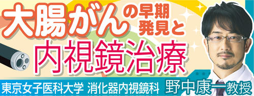 大腸がんの早期発見と内視鏡治療