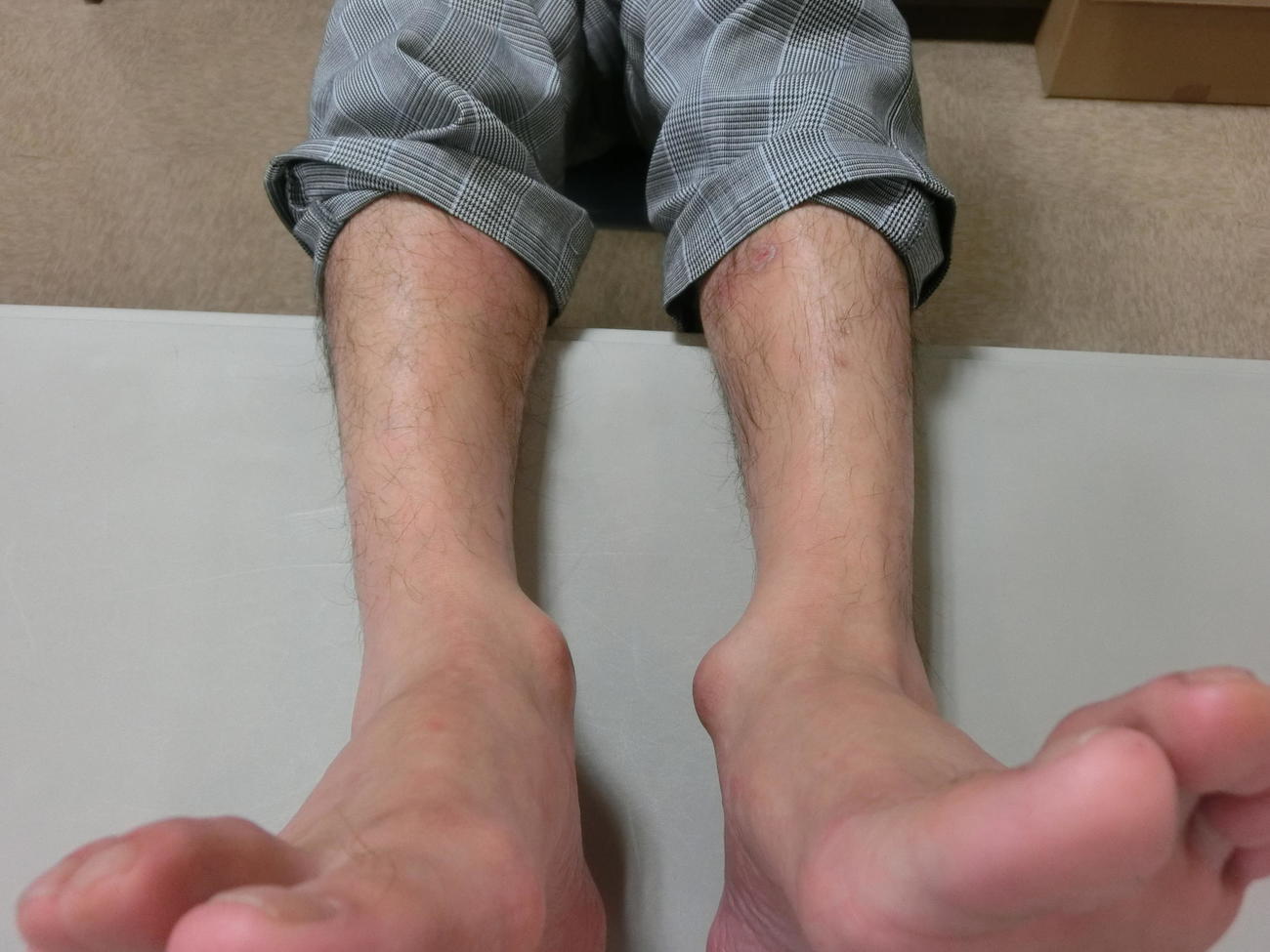 腫れ上がった的場文男騎手のくるぶし（18年8月撮影）
