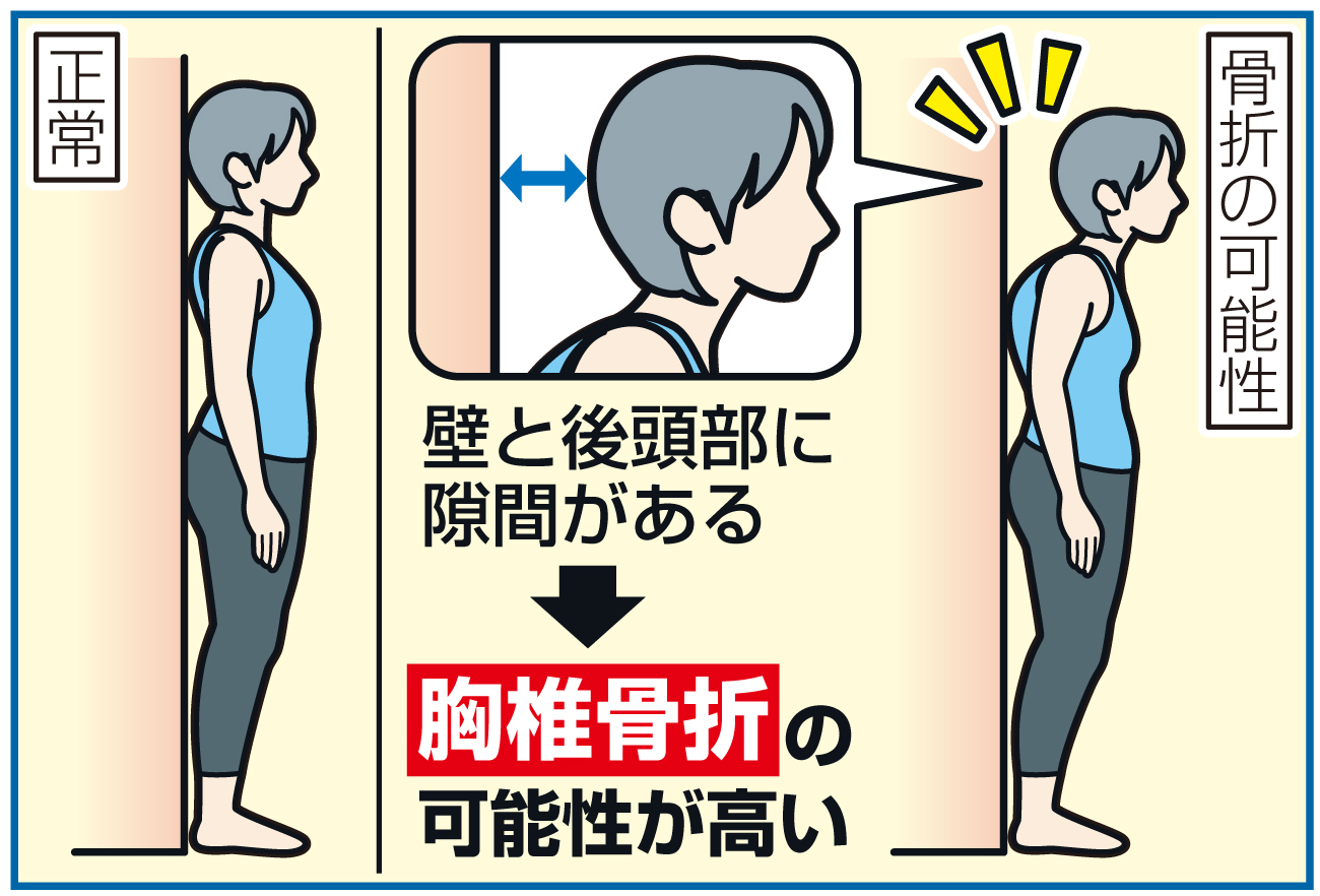胸椎骨折の簡単な推定法