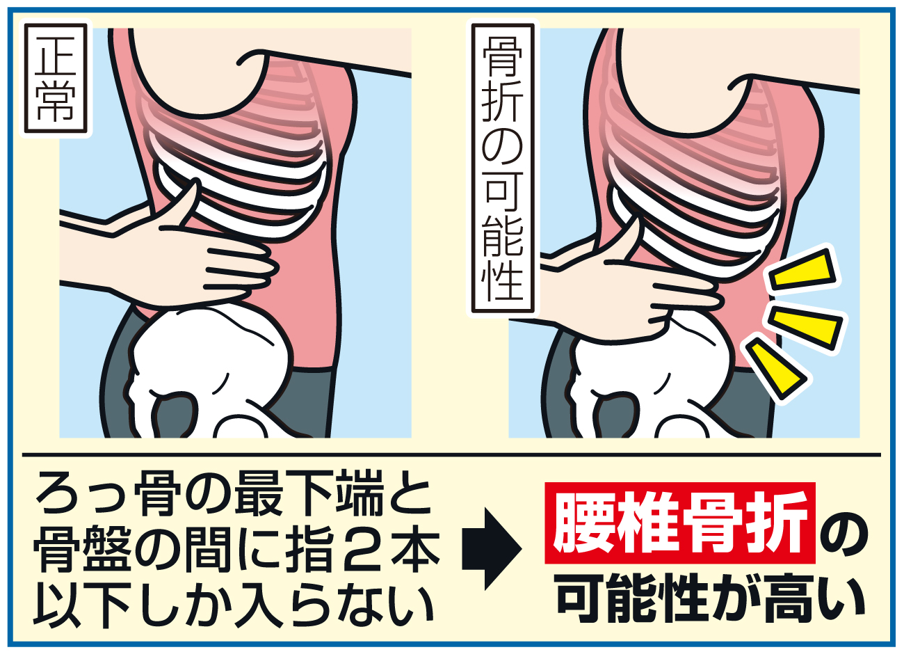 腰椎骨折チェック方法
