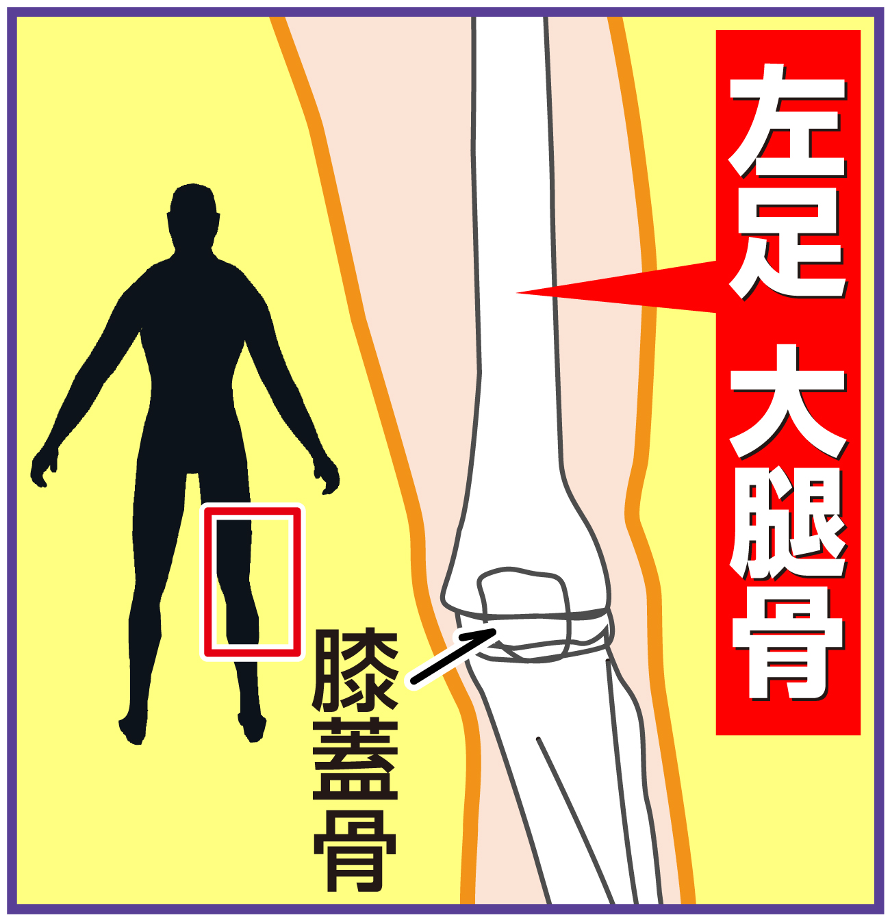 【イラスト】左足の大腿骨